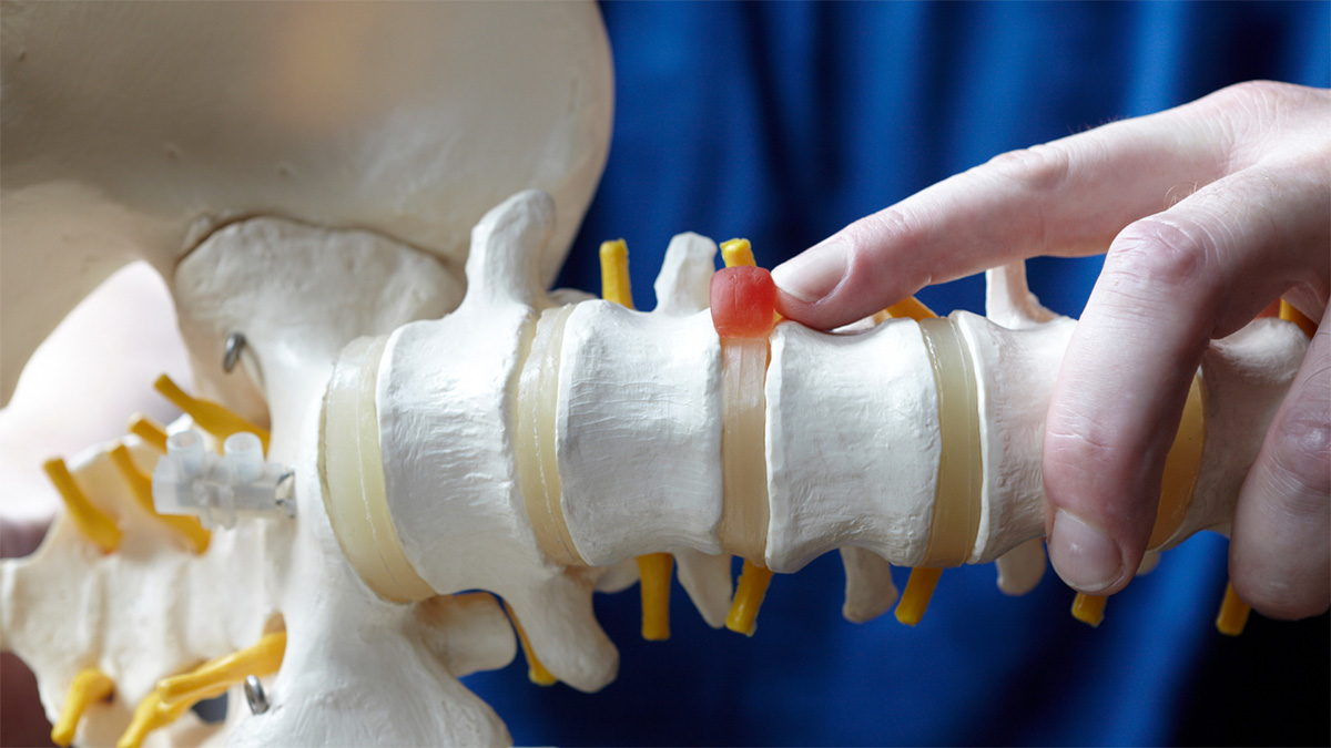 Eine Modell einer Wirbelsäule zeigt einen Bandscheibenvorfall.