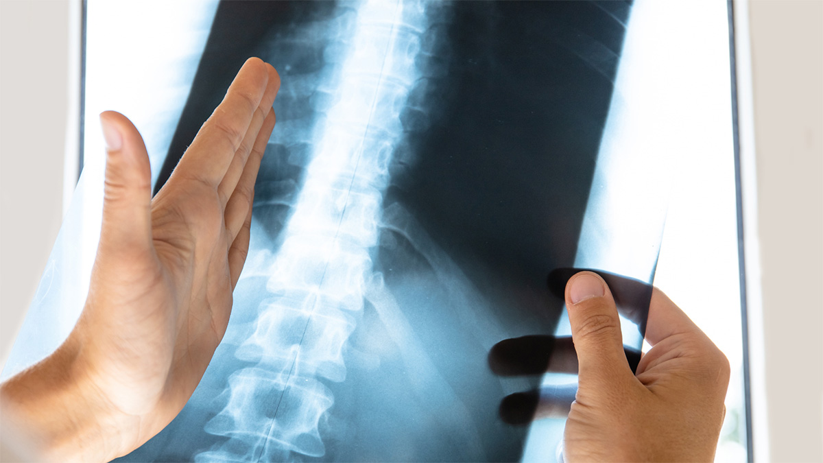 Ein Arzt schaut sich das Röntgenbild der Wirbelsäule seines Patienten an. 